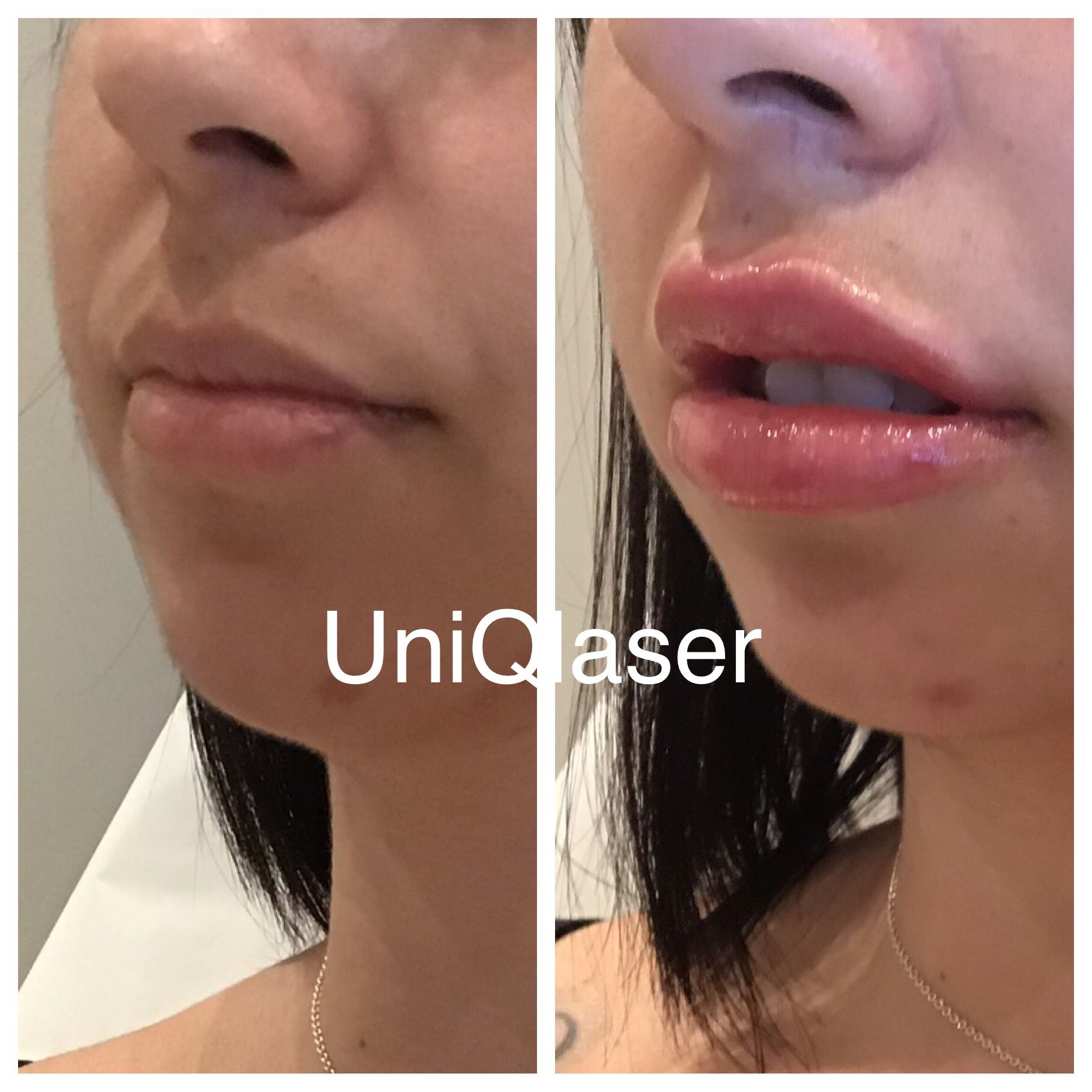 Juvederm Voluma before and after photos by UniQ Laser Center in Canton, MA