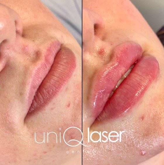 Restylane Kysse before and after photos by UniQ Laser Center in Canton, MA