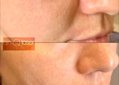 Restylane Kysse before and after photos by UniQ Laser Center in Canton, MA