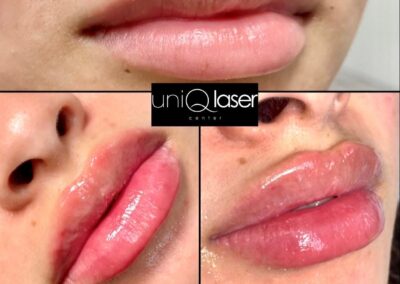 Restylane Kysse before and after photos by UniQ Laser Center in Canton, MA