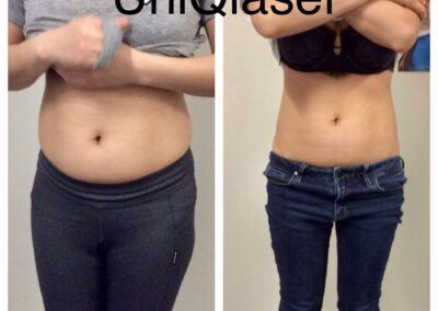 CoolSculpting before and after photos by UniQ Laser Center in Canton, MA