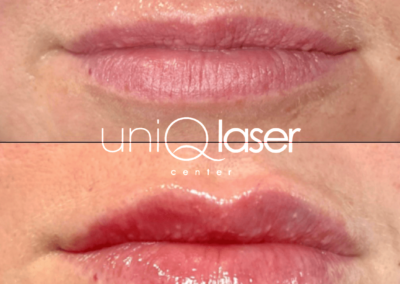 Restylane Kysse before and after photos by UniQ Laser Center in Canton, MA