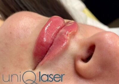 Restylane Kysse before and after photos by UniQ Laser Center in Canton, MA