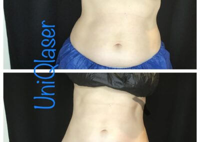 CoolSculpting before and after photos by UniQ Laser Center in Canton, MA