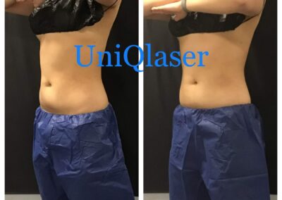CoolSculpting before and after photos by UniQ Laser Center in Canton, MA
