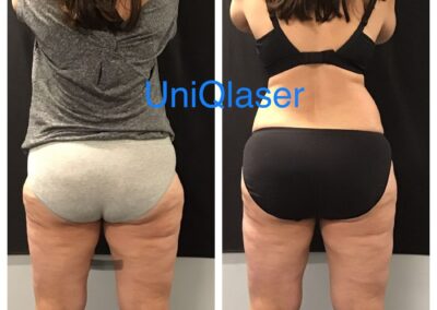 CoolSculpting before and after photos by UniQ Laser Center in Canton, MA