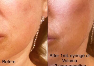 Juvederm Voluma before and after photos by UniQ Laser Center in Canton, MA