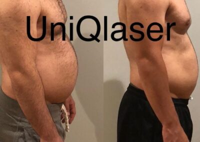 Coolsculpting before and after photos by UniQ Laser Center in Canton, MA
