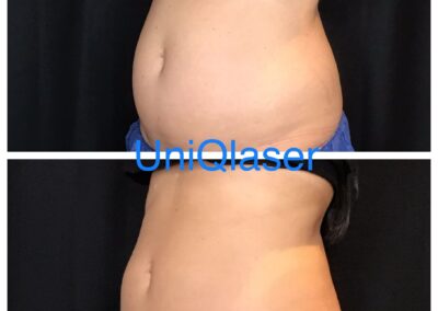 CoolSculpting before and after photos by UniQ Laser Center in Canton, MA