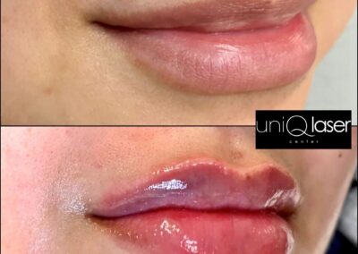 Restylane Kysse before and after photos by UniQ Laser Center in Canton, MA