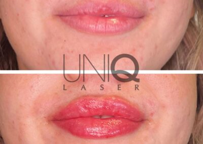 Lip Filler before and after photo by UniQ Laser Center in Canton MA