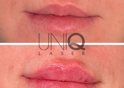 Lip Filler before and after photo by UniQ Laser Center in Canton MA