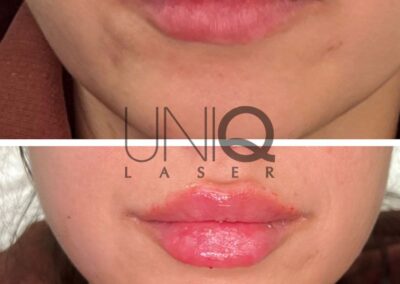 Lip Filler before and after photo by UniQ Laser Center in Canton MA