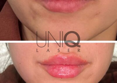 Lip Filler before and after photo by UniQ Laser Center in Canton MA