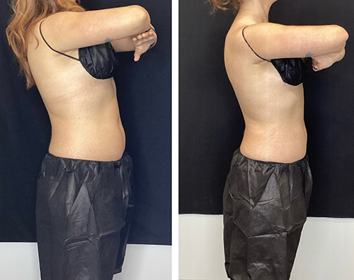 Coolsculpting Before and After Photos by UniQ Laser Center in Canton Watertown Saugus MA