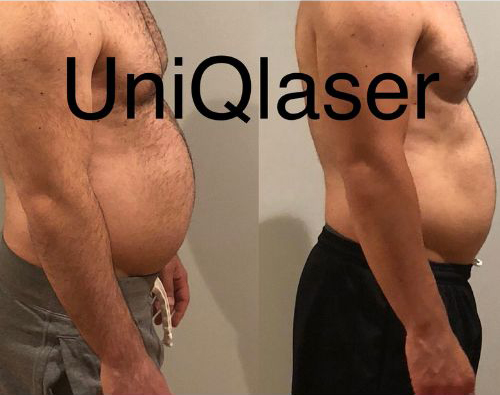 UniQLaser CoolSuclpting Gallery Images ac