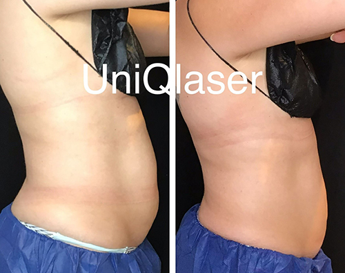 Coolsculpting Before and After Photos by UniQ Laser Center in Canton Watertown Saugus MA