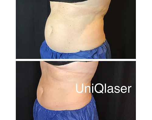 UniQLaser CoolSuclpting Gallery Images ac
